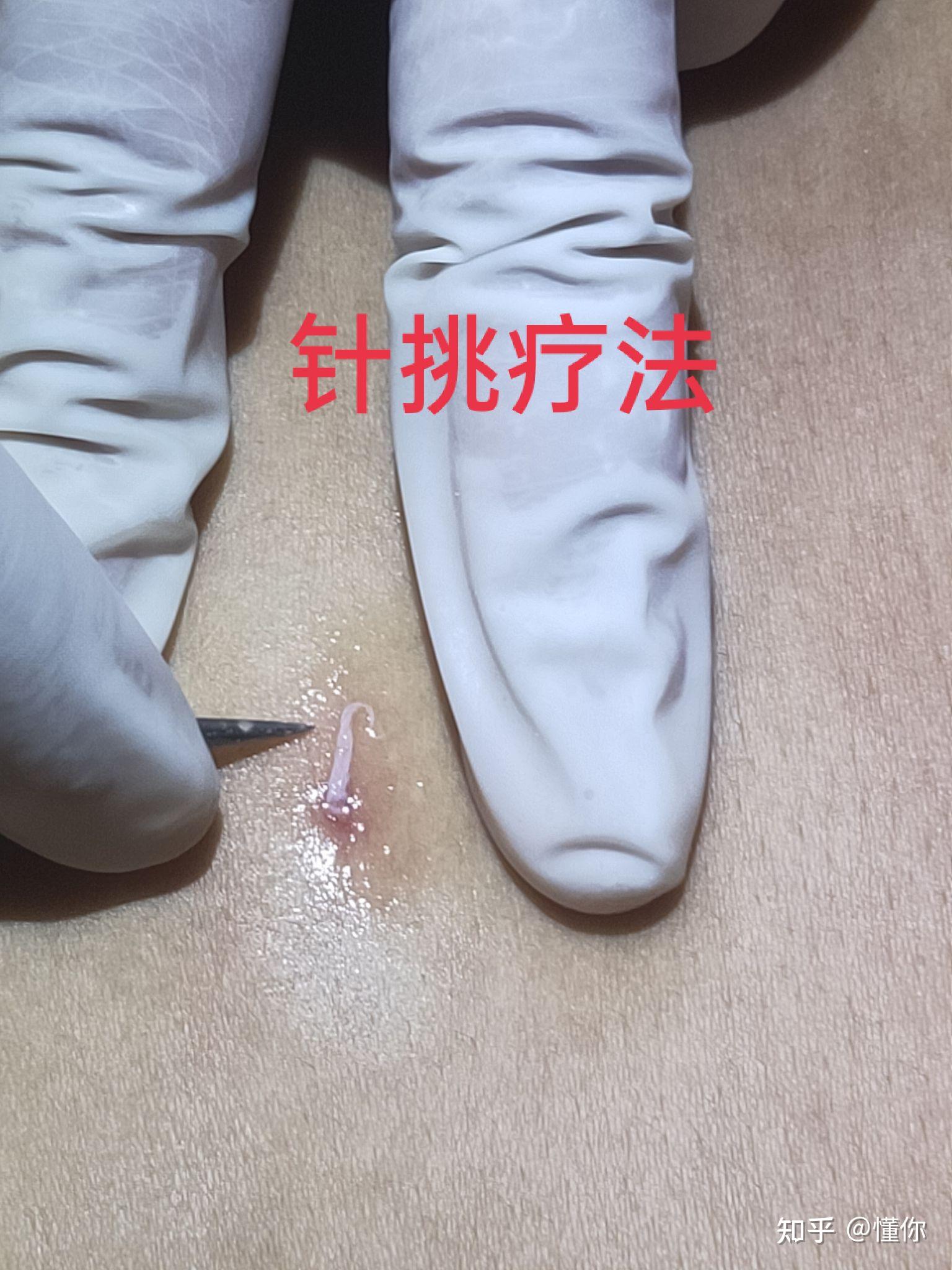 南昌归元堂挑羊毛疔董氏挑痔挑羊毛疔