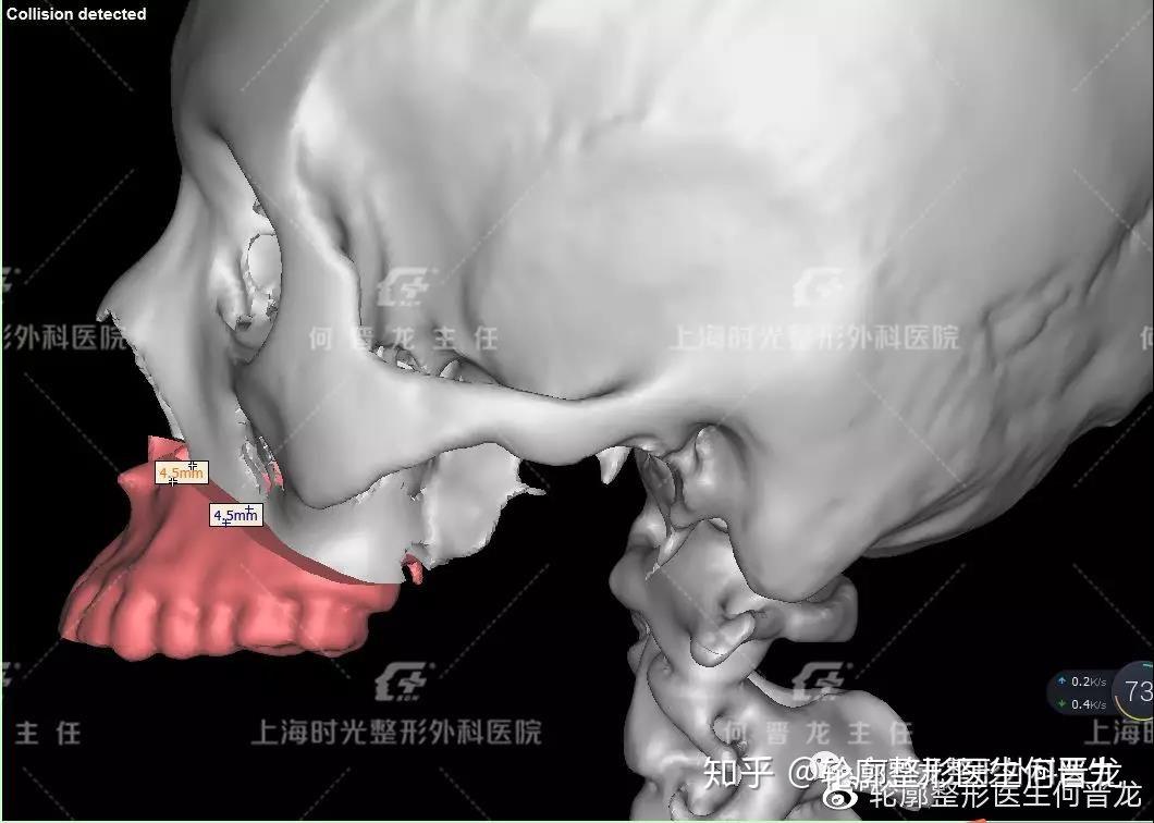 做正颌手术是怎样的体验