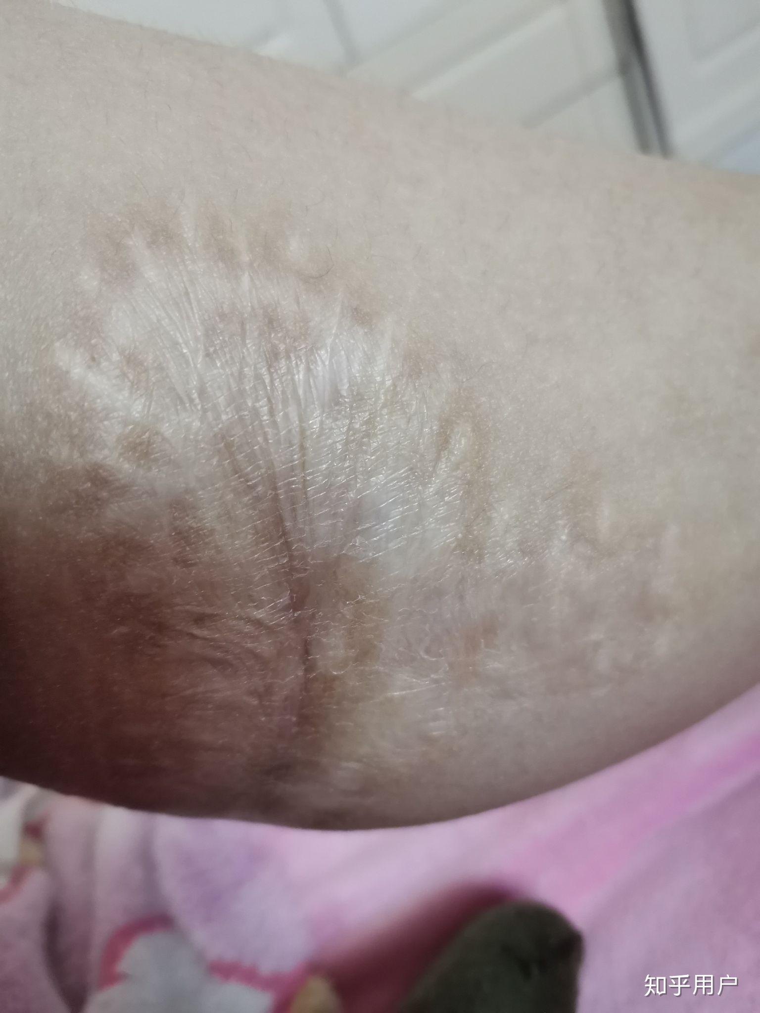 有没有人因腿上有大面积疤,十几年都没穿过短裤短裙? - 知乎