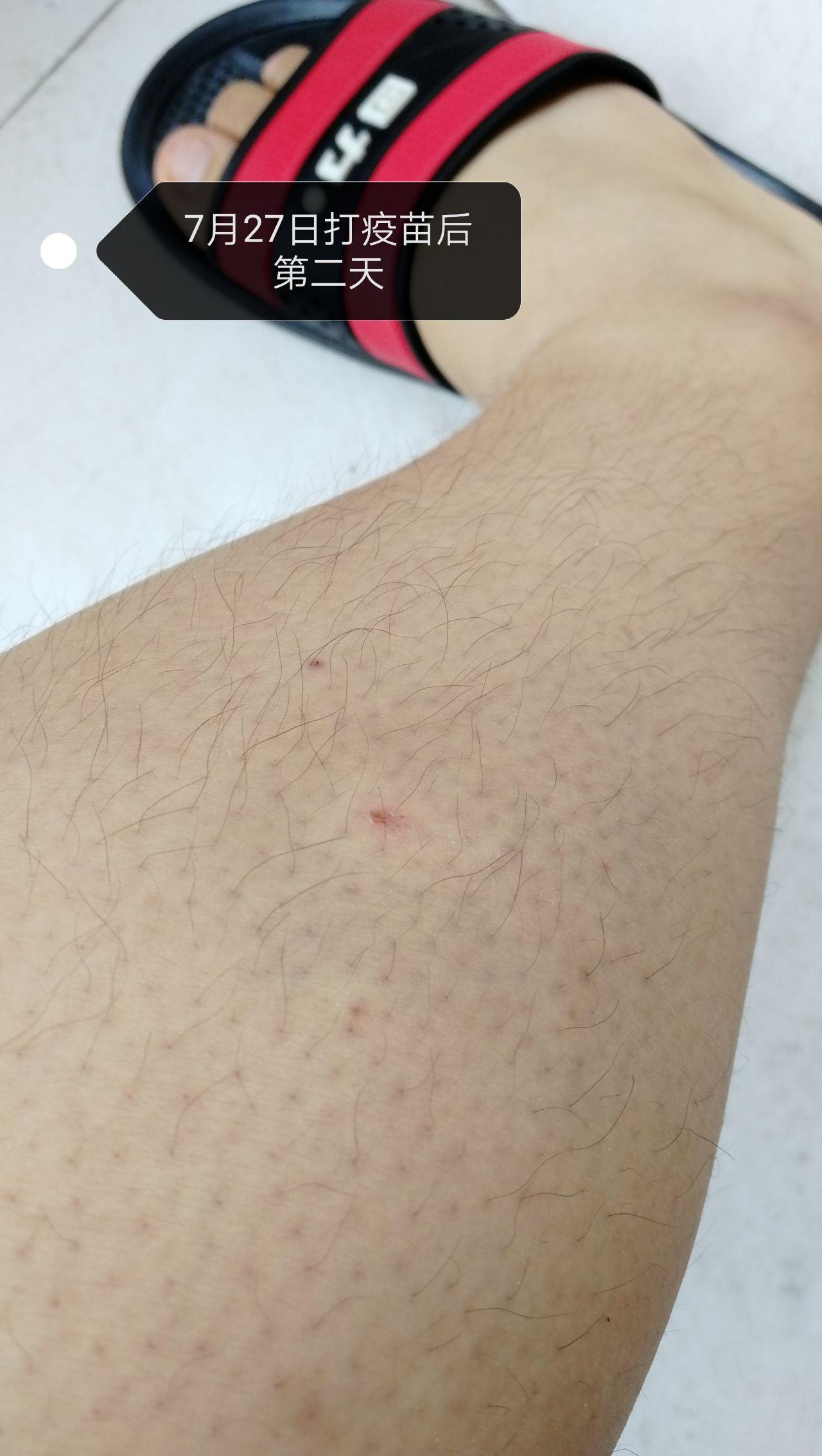 被狗咬了是一种什么样的体验