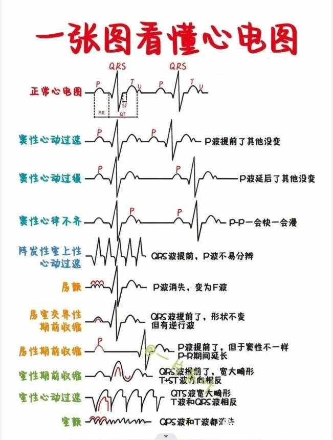 一张图看懂心电图 心电图 知乎 
