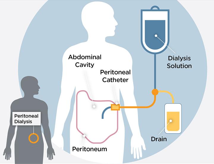 每日一词:肾脏透析 (Kidney dialysis) - 知乎