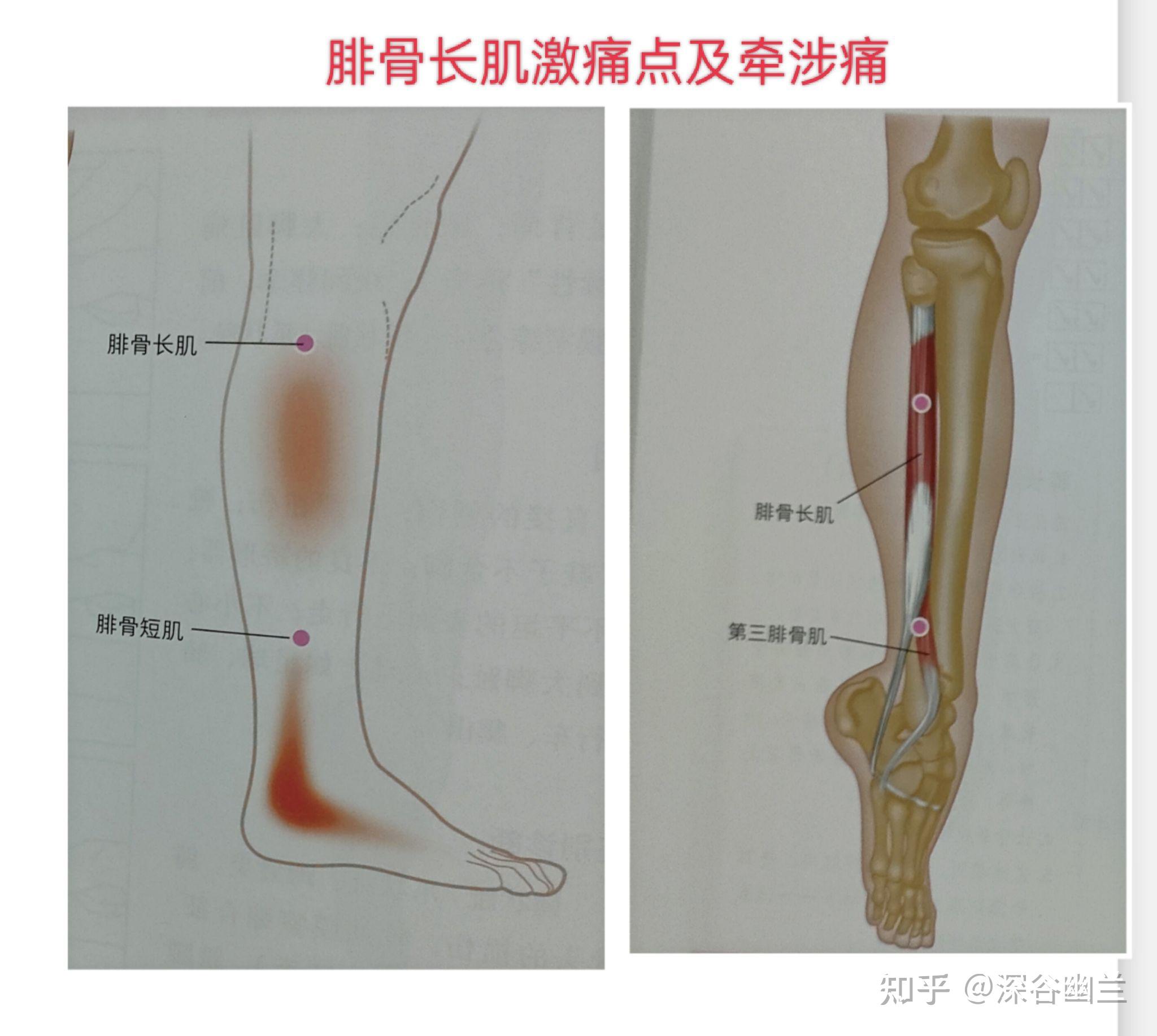 膝盖外侧疼痛的激痛点及穴位 - 知乎