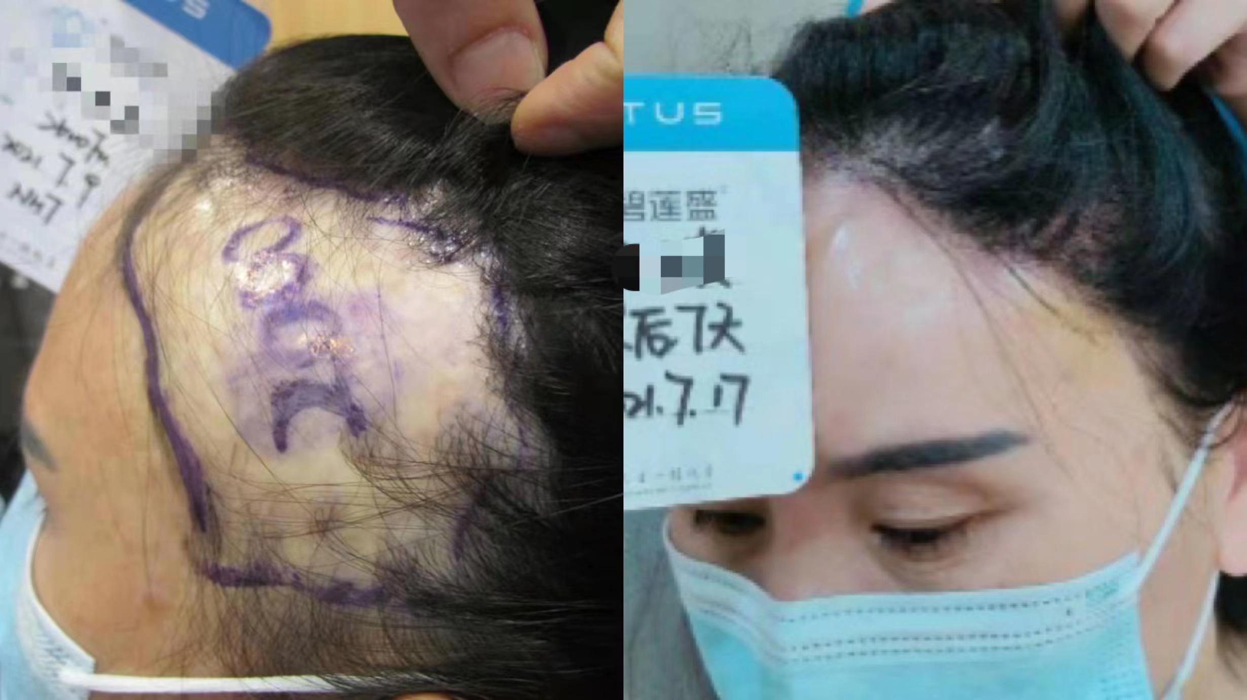 手术疤可以植发吗(手术疤可以植发吗多少钱)