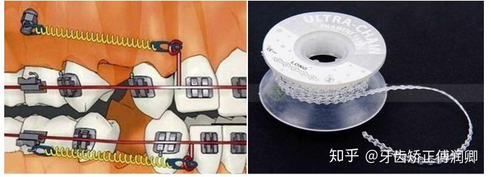 通常会使用橡皮筋(每天病人自己更换),拉簧,橡皮链.