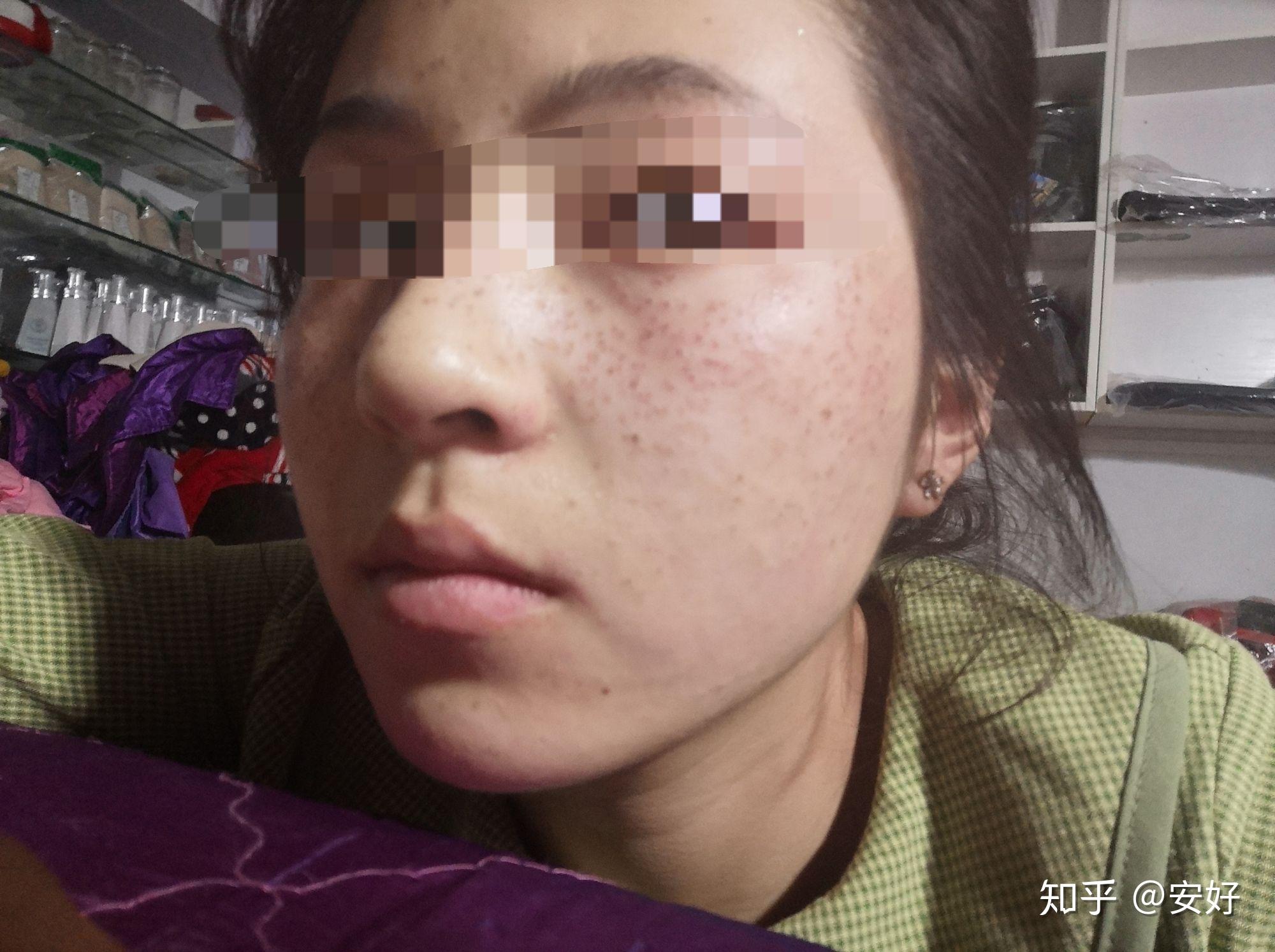 有什么好方法能让脸上的痘印消失？ - 知乎