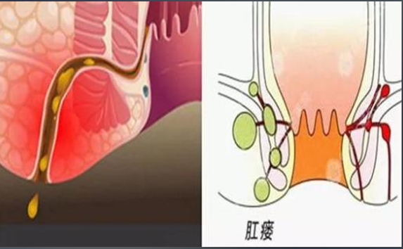 肛裂手术到底多久能恢复?