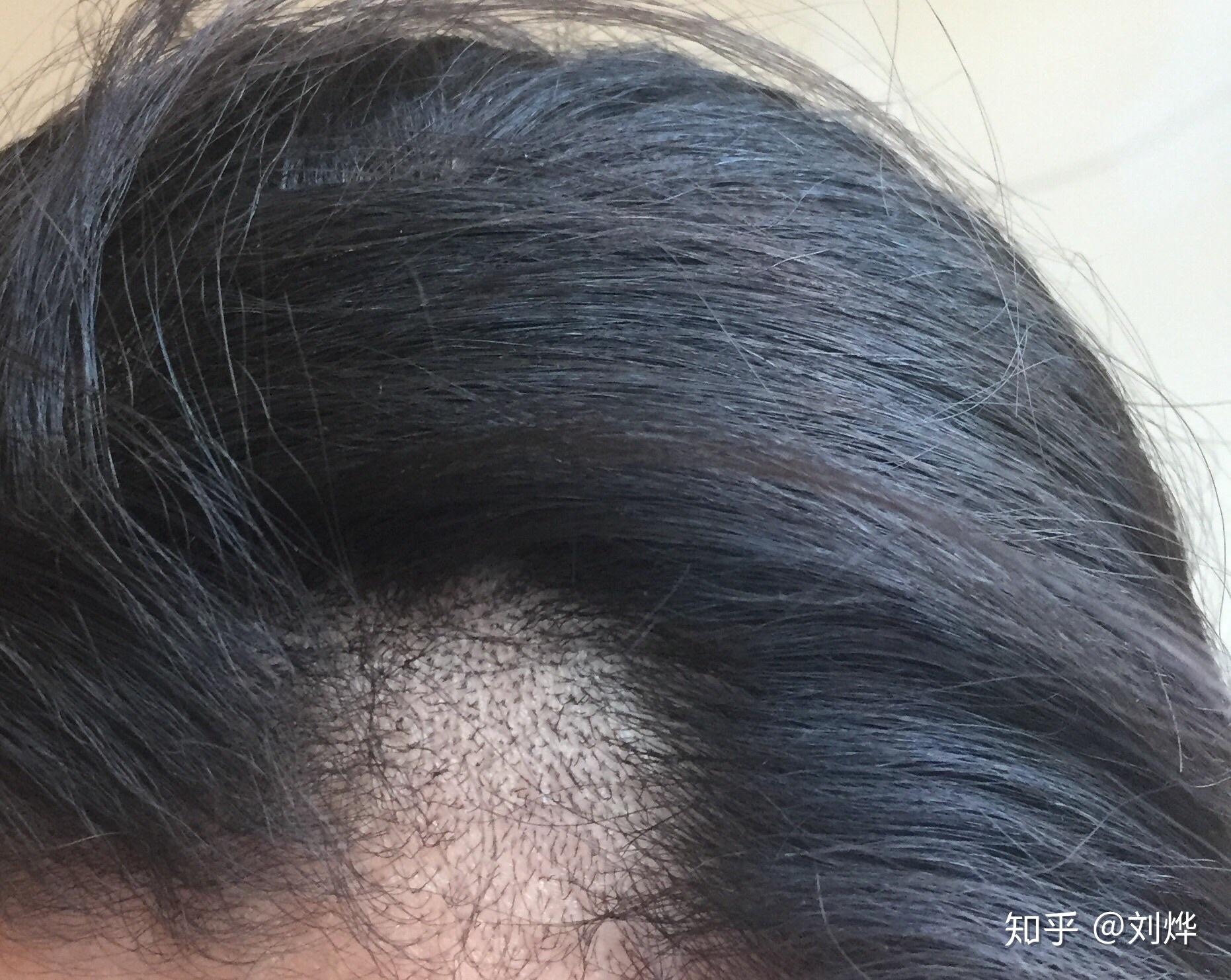 生活上7个最常见的断发原因，中招越多断发越多，尤其是第4个_头发