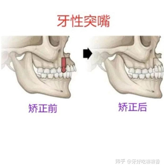 骨性和牙性的区别图片图片