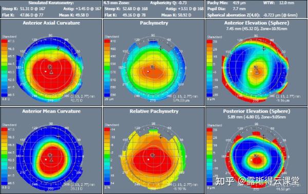 圆锥角膜的RGP验配及RGP临床效果分析（文字版） - 知乎