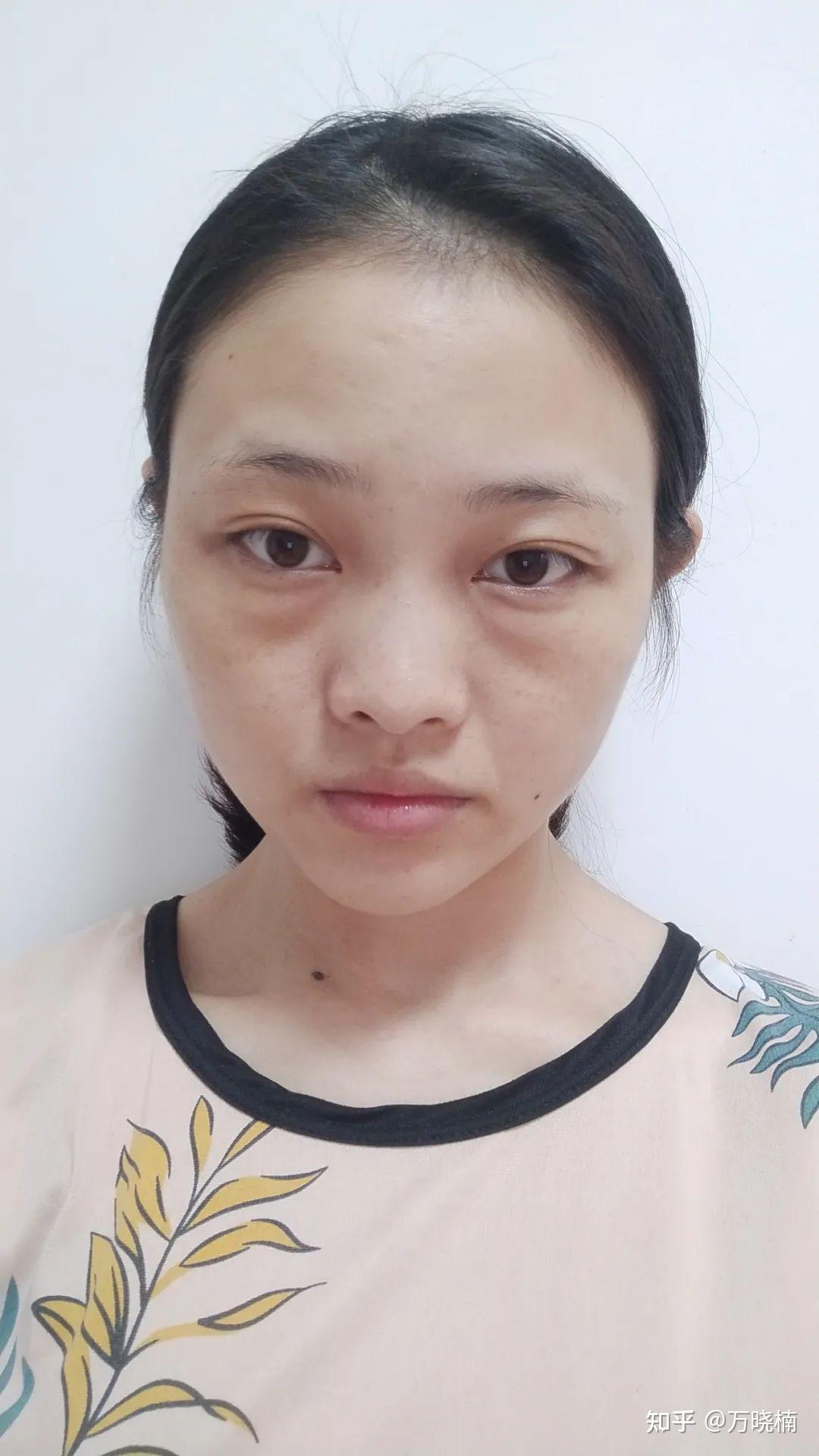 面部松弛凹陷,不知先做提升还是填充? - 知乎