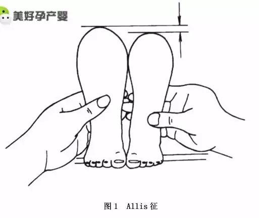 婴儿髋关节自测图图片