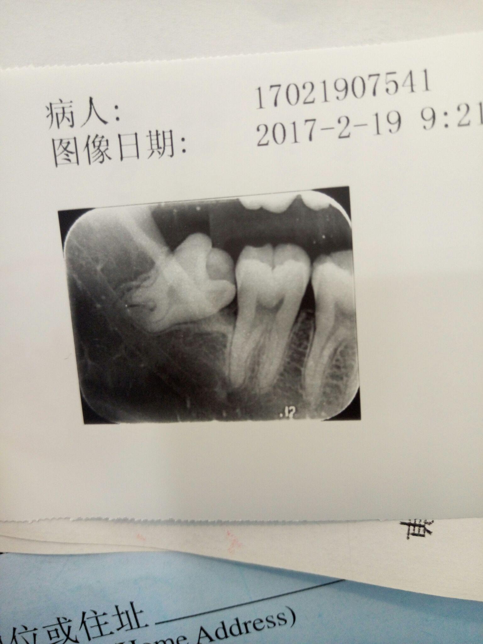 牙片,阻生牙,说拔牙切创面比较大,如果平日注意刷牙刷到这个智齿可以