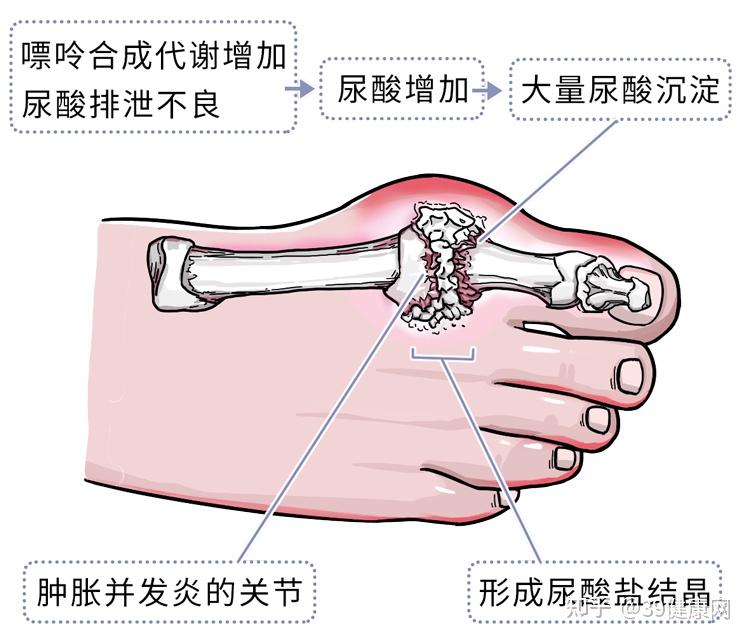 尿酸高身体会有那些反应