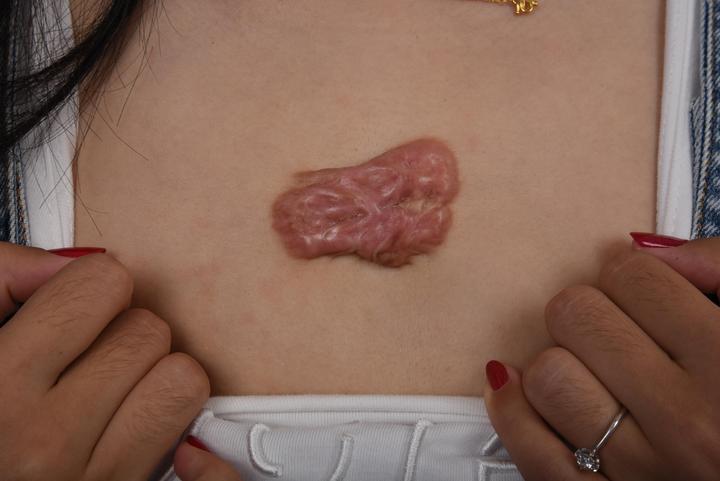 抗瘢日记丨胸前瘢痕疙瘩手术,植皮加防复发治疗