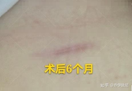 恢复后有疤痕吗?