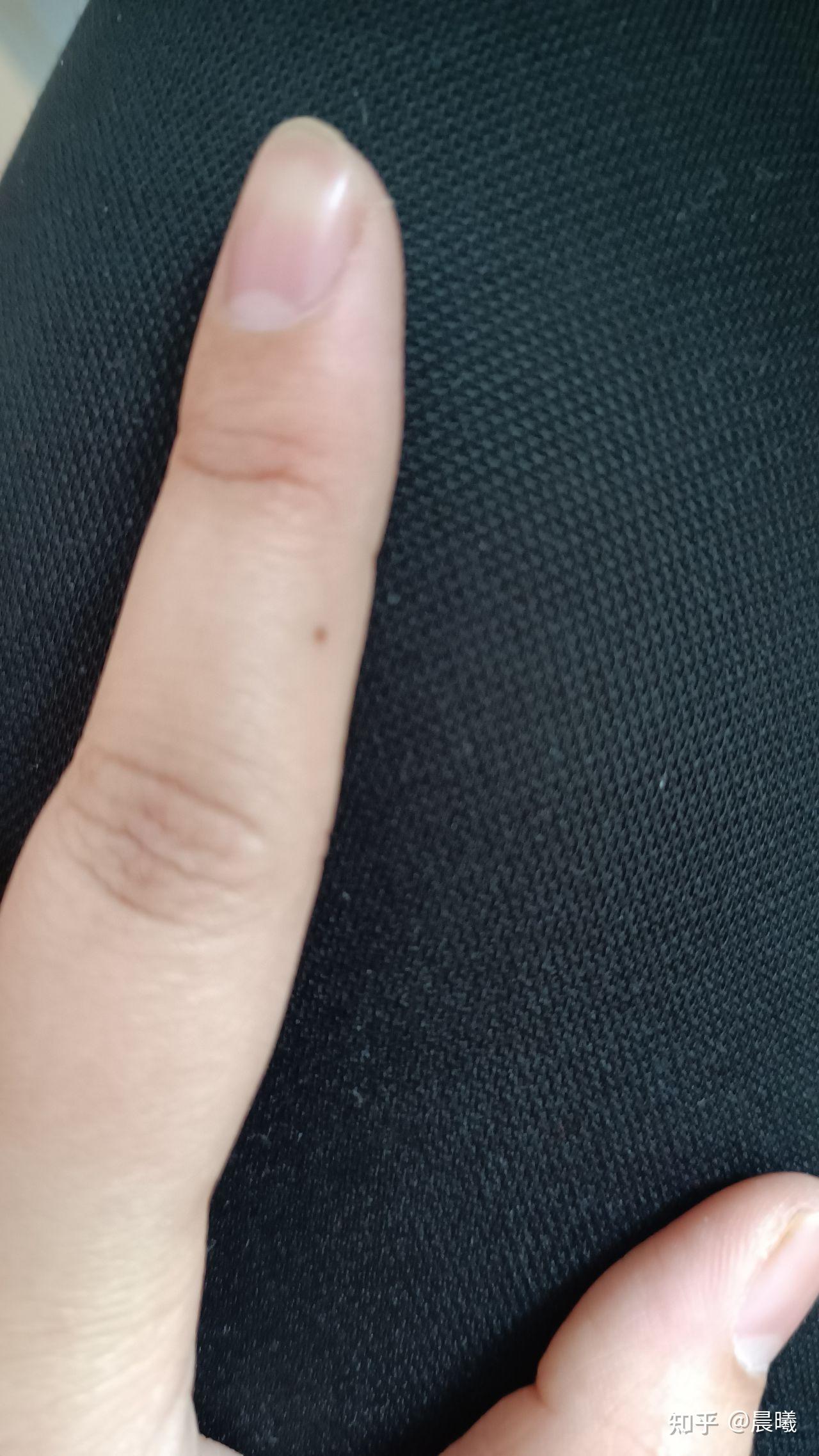 女生左手食指有痣图片