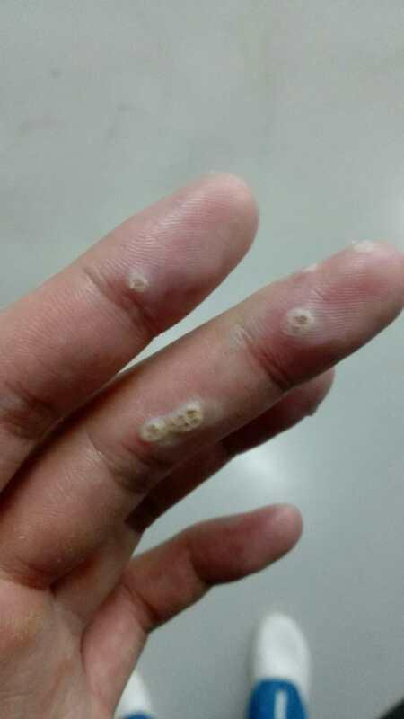 治疗手指上的寻常疣(鱼鳞痣)有什么办法,或者药物? - 知乎