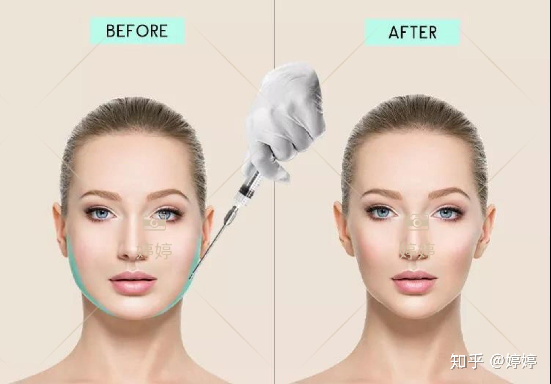 可以通过哪些整容方法改变脸型