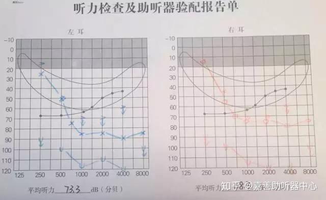 听觉功能退化患者的干预 - 知乎