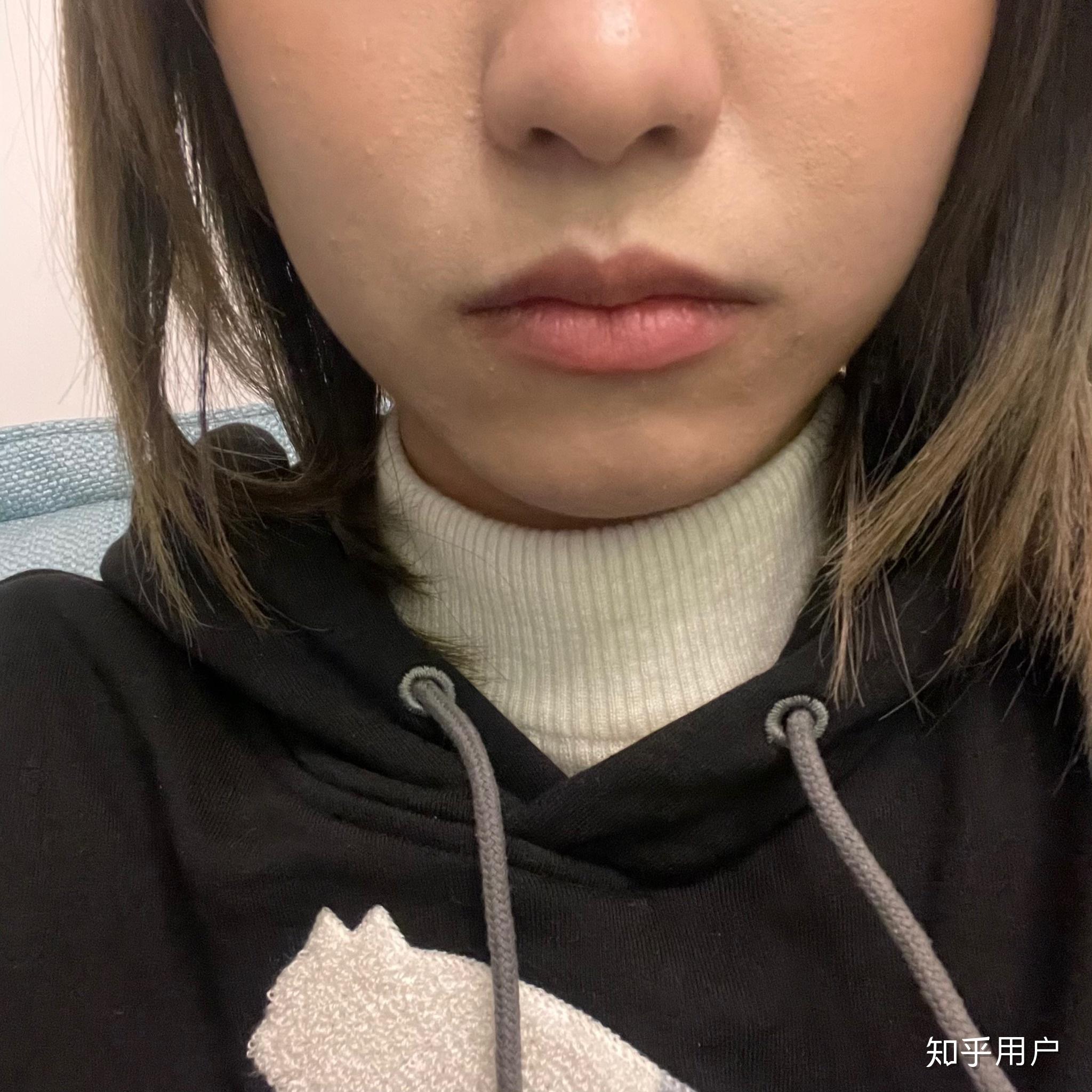 为什么嘴巴两边(嘴角)会有凸出来的肉肉?