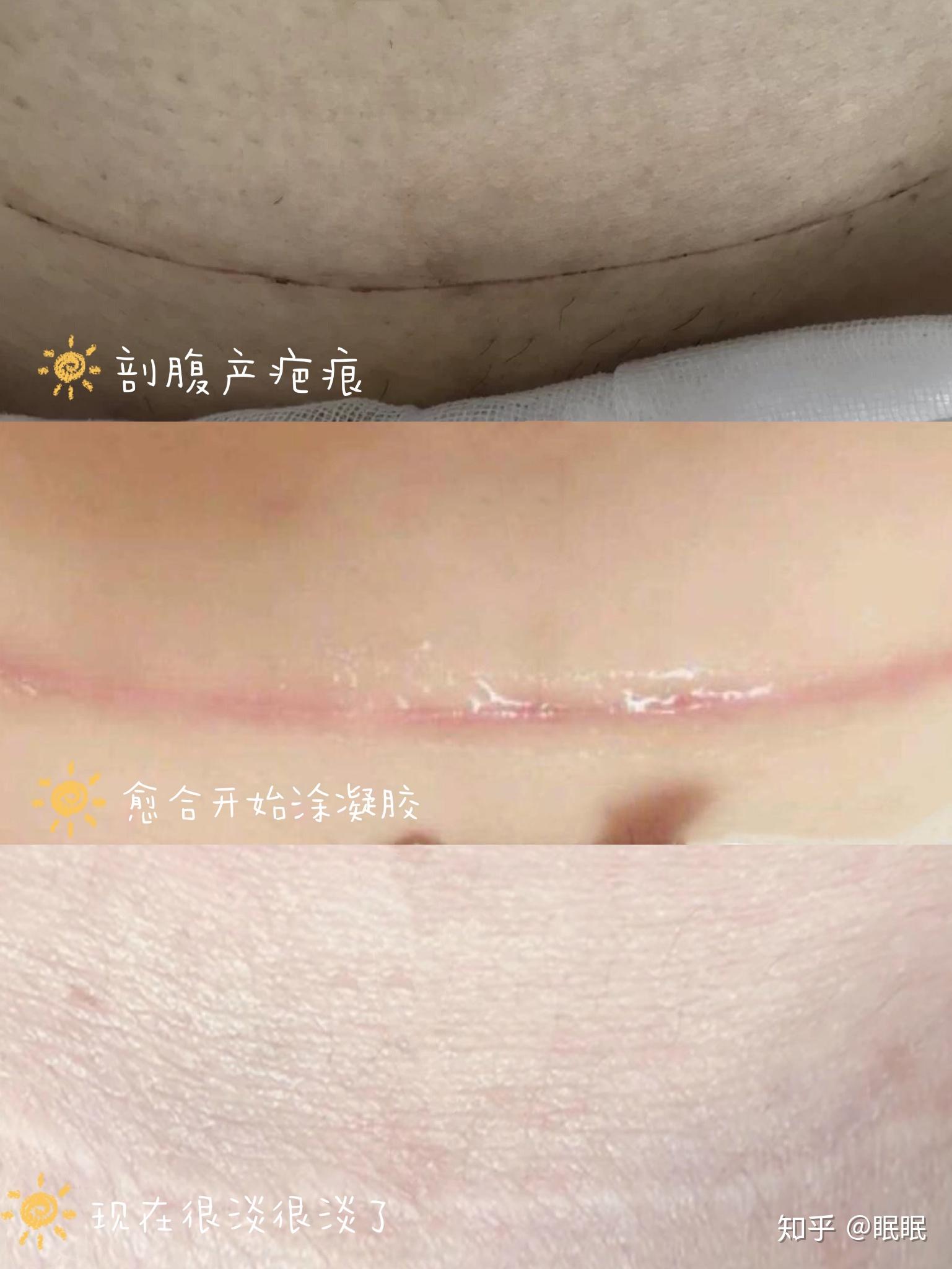 什么情况下孕妇应该选择剖腹产剖腹产后的刀疤一般多久会彻底恢复