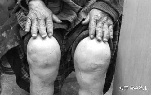 硒缺乏:会导致克山病,大骨节病等40多种疾病,这些病症常常发生在硒