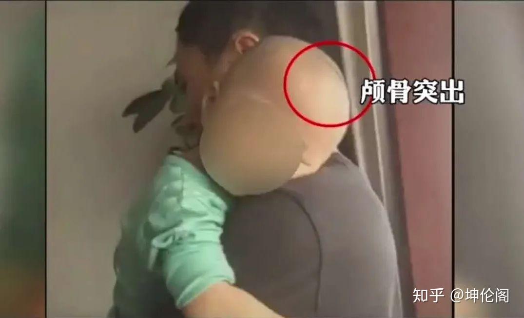 "三鹿奶粉"12年后,湖南又现大头娃娃!拿宝宝赚黑心钱,良心不会痛吗?