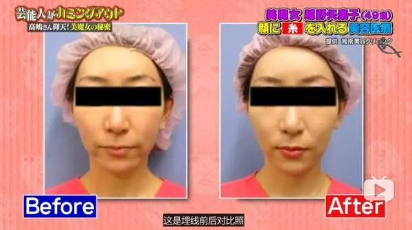 13万做鼻整形效果不满 恢复期过后脱胎换骨然后去当艺人也是赚了 知乎