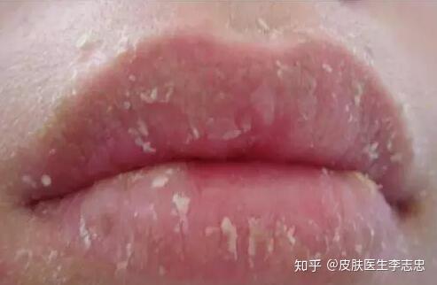 嘴唇干燥 脱屑 干裂 水肿 瘙痒和灼痛 一副泻黄散就能搞定 知乎
