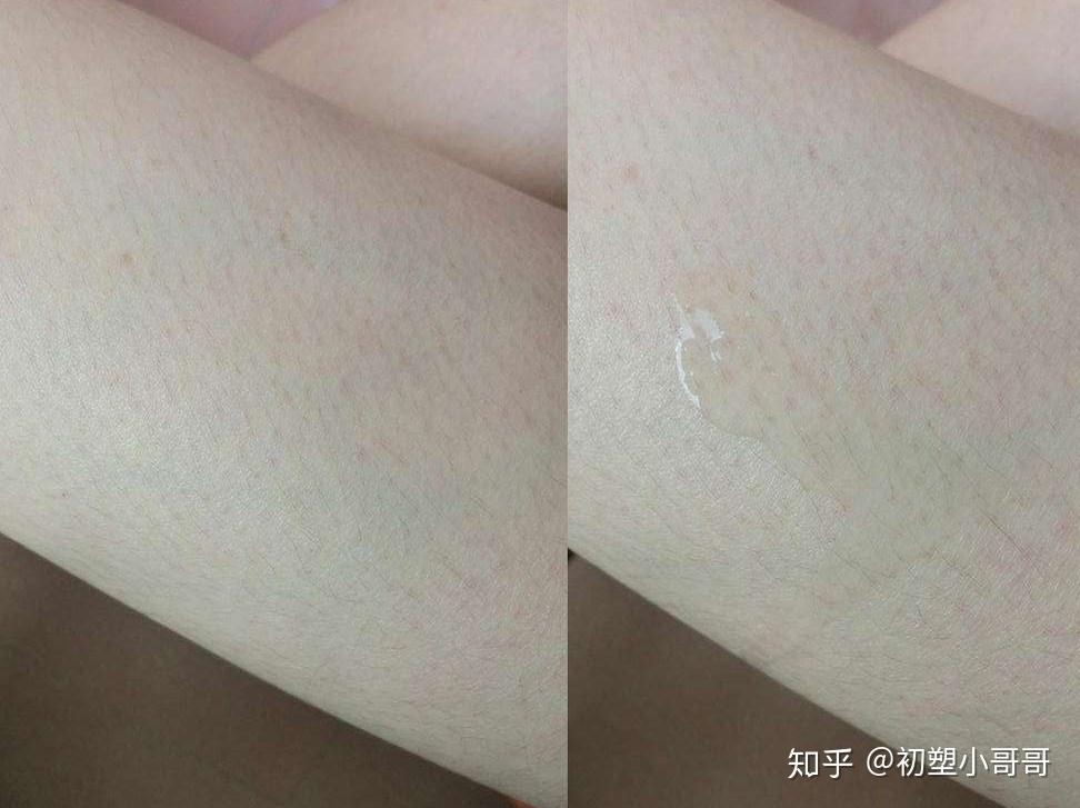 雞皮膚怎麼消除最有效這些方法幫你巧去雞皮膚