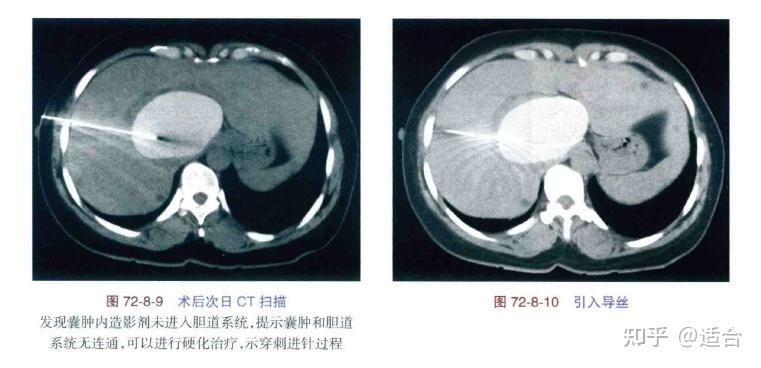 肝包膜下积液ct图片图片