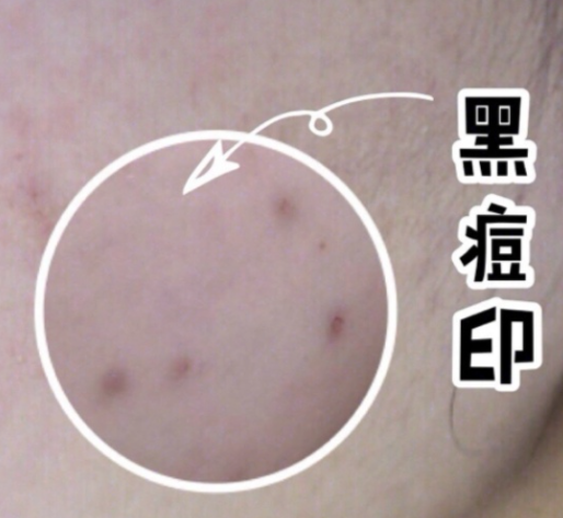 痘痘去除了留下红色痘印黑色痘印怎么解决