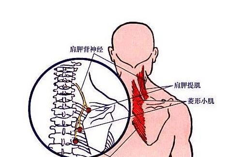 肩胛背神经卡压综合征