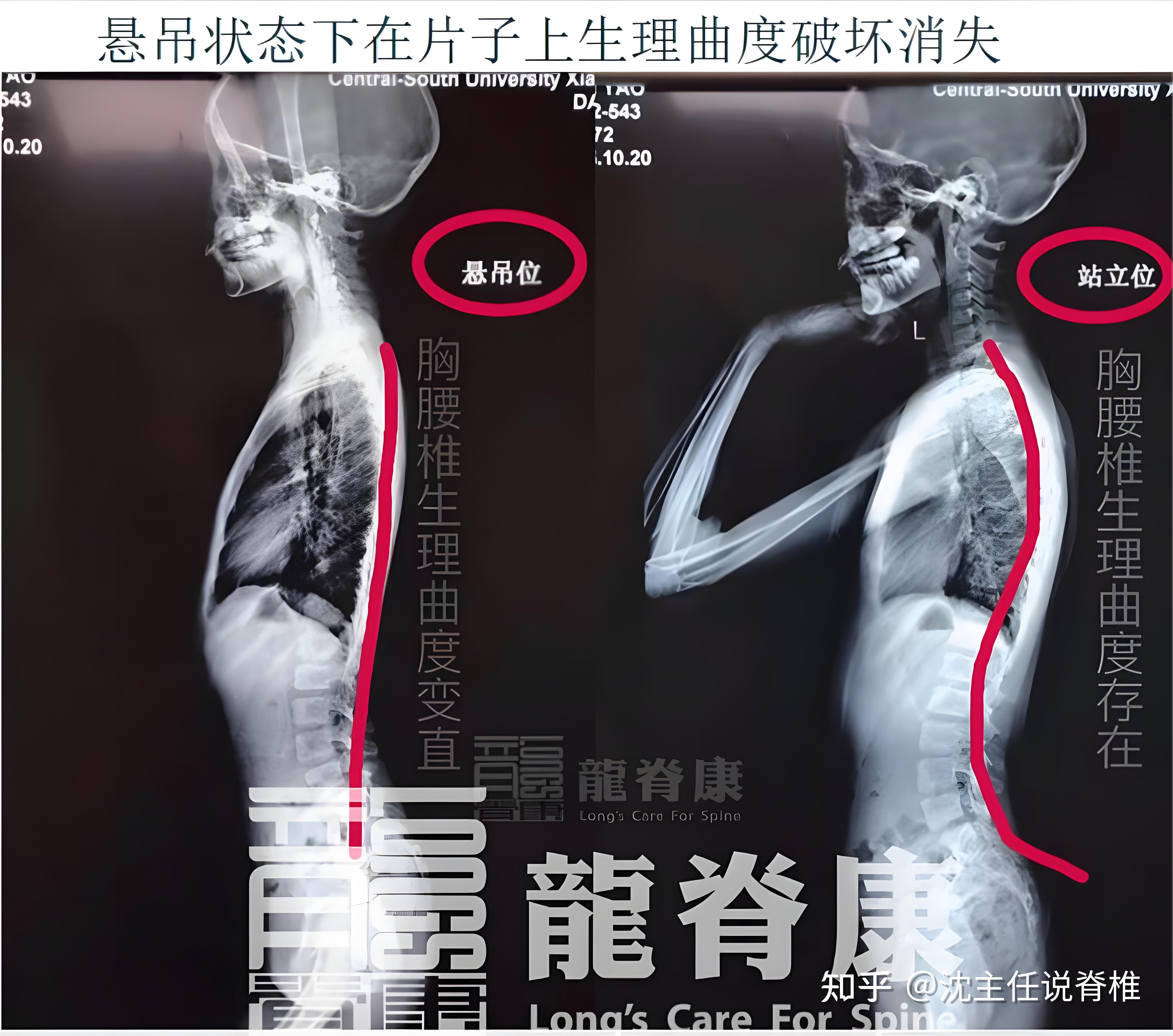 生理曲度变直、反弓,是怎么回事?可以做哪些锻炼? - 知乎