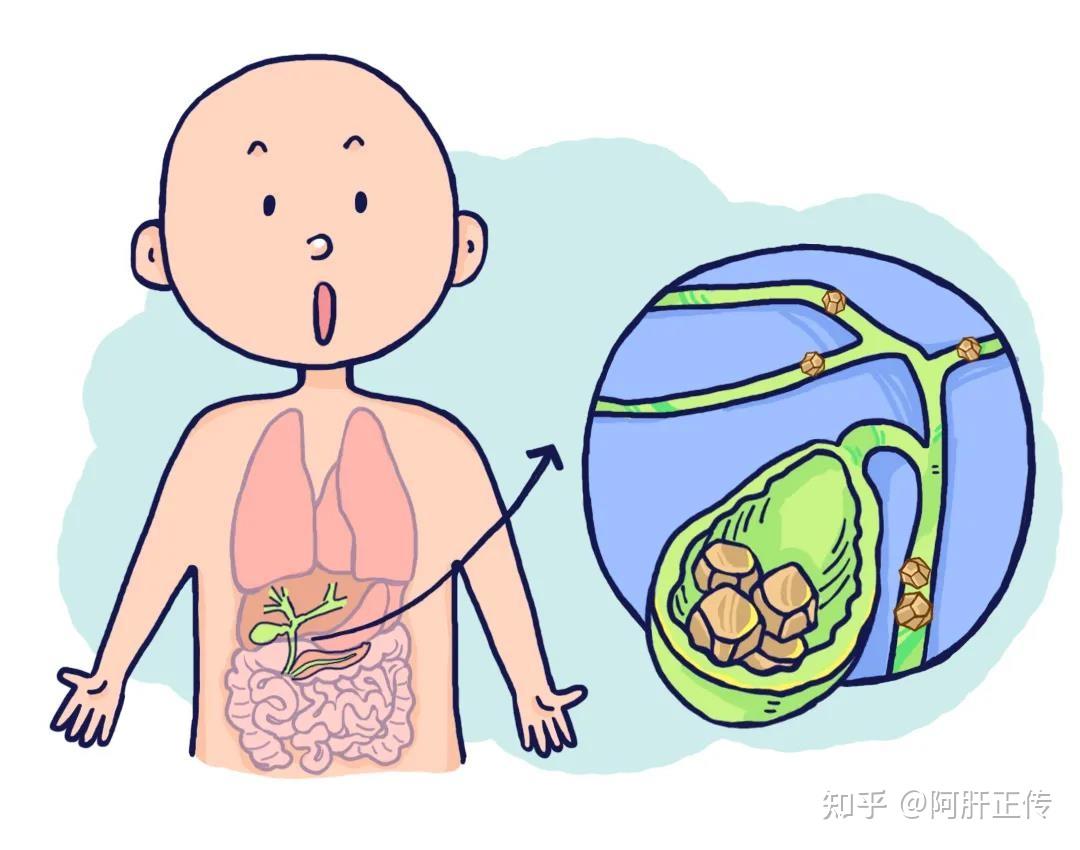 胆道系统，胆囊和胆管内发生结石的疾病