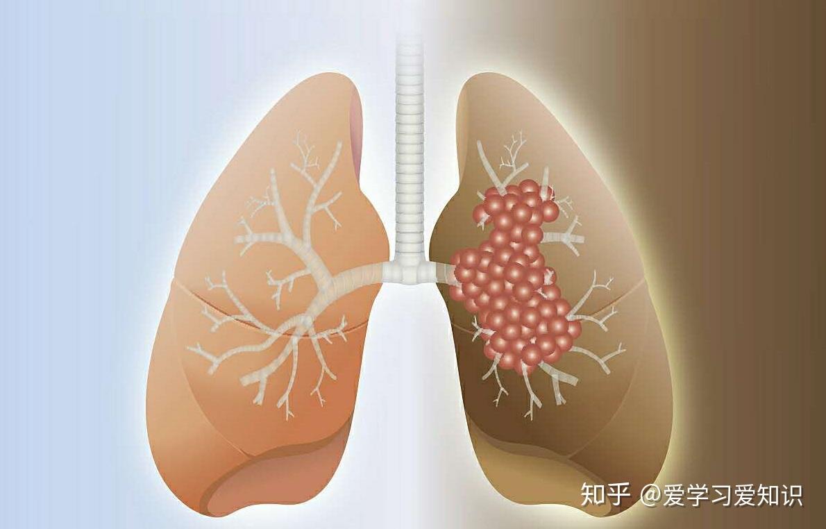 肺癌会传染吗图片