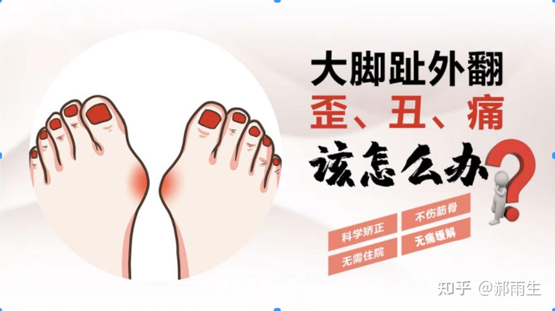 郝雨生解说，脚趾拇外翻矫正器有用吗? - 知乎