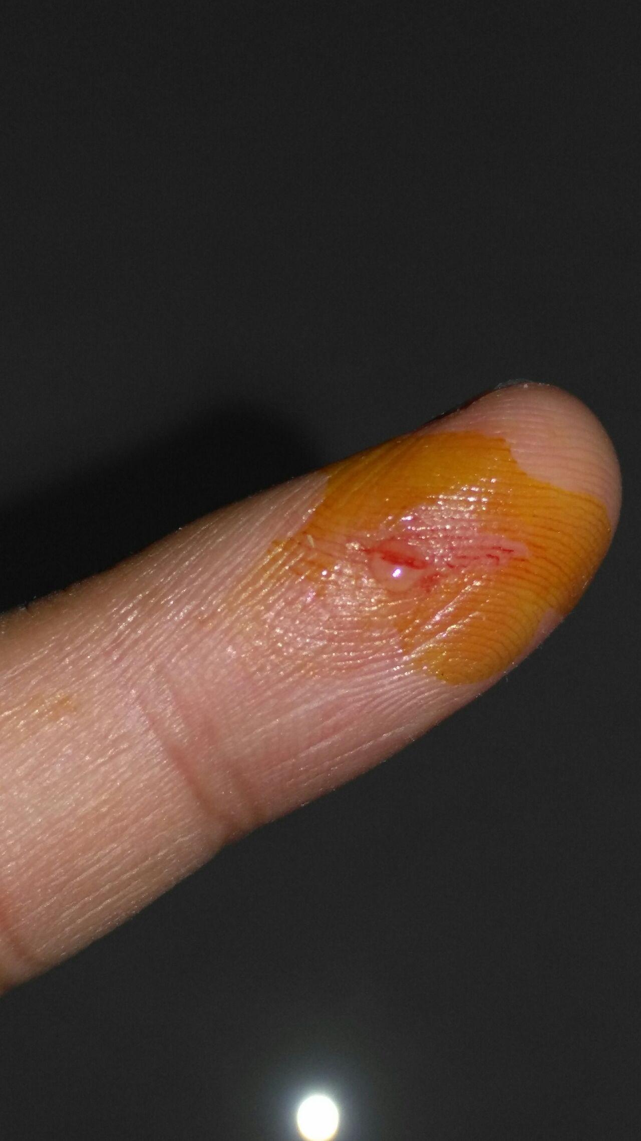 被乌龟咬了怎么处理伤口怎么治疗