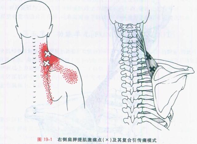再看肩胛提肌损伤