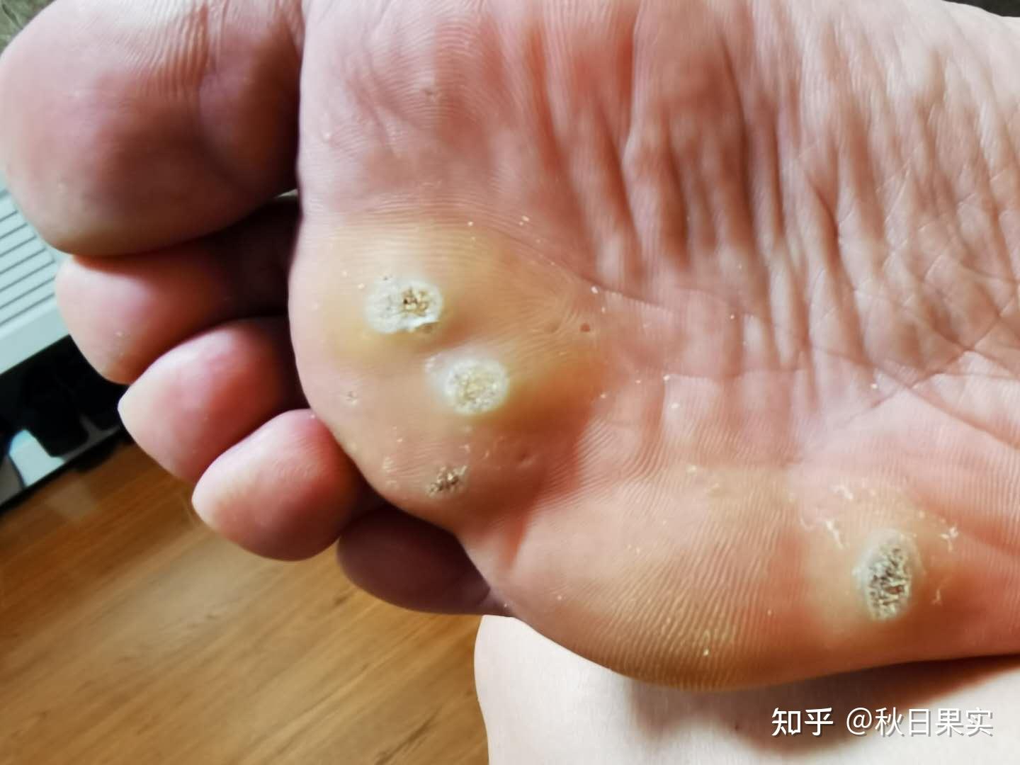 蹠疣最佳治療方法到底是什麼