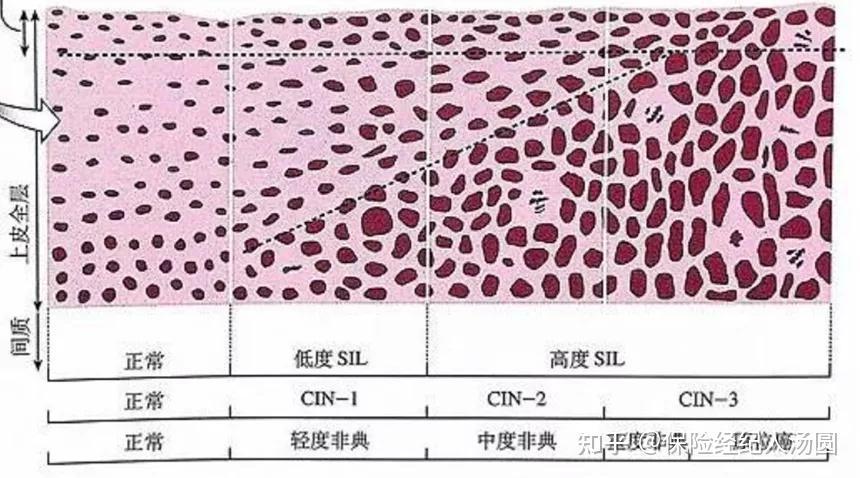 确诊宫颈原位癌|高级别鳞状上皮内病变lsil|cin3级,我还能再买到保险
