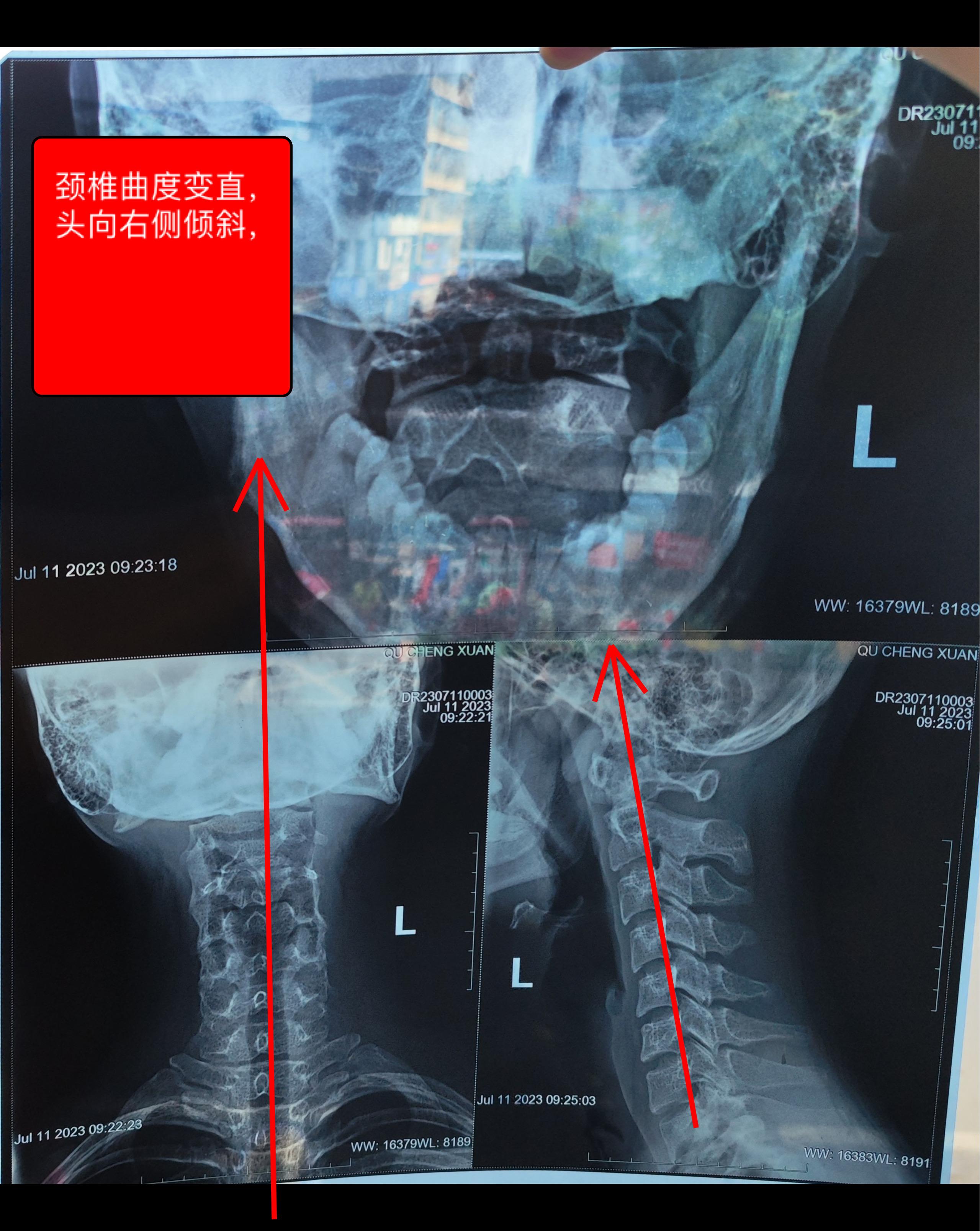 颈椎病是否会引起全身无力,眩晕,嗜睡?