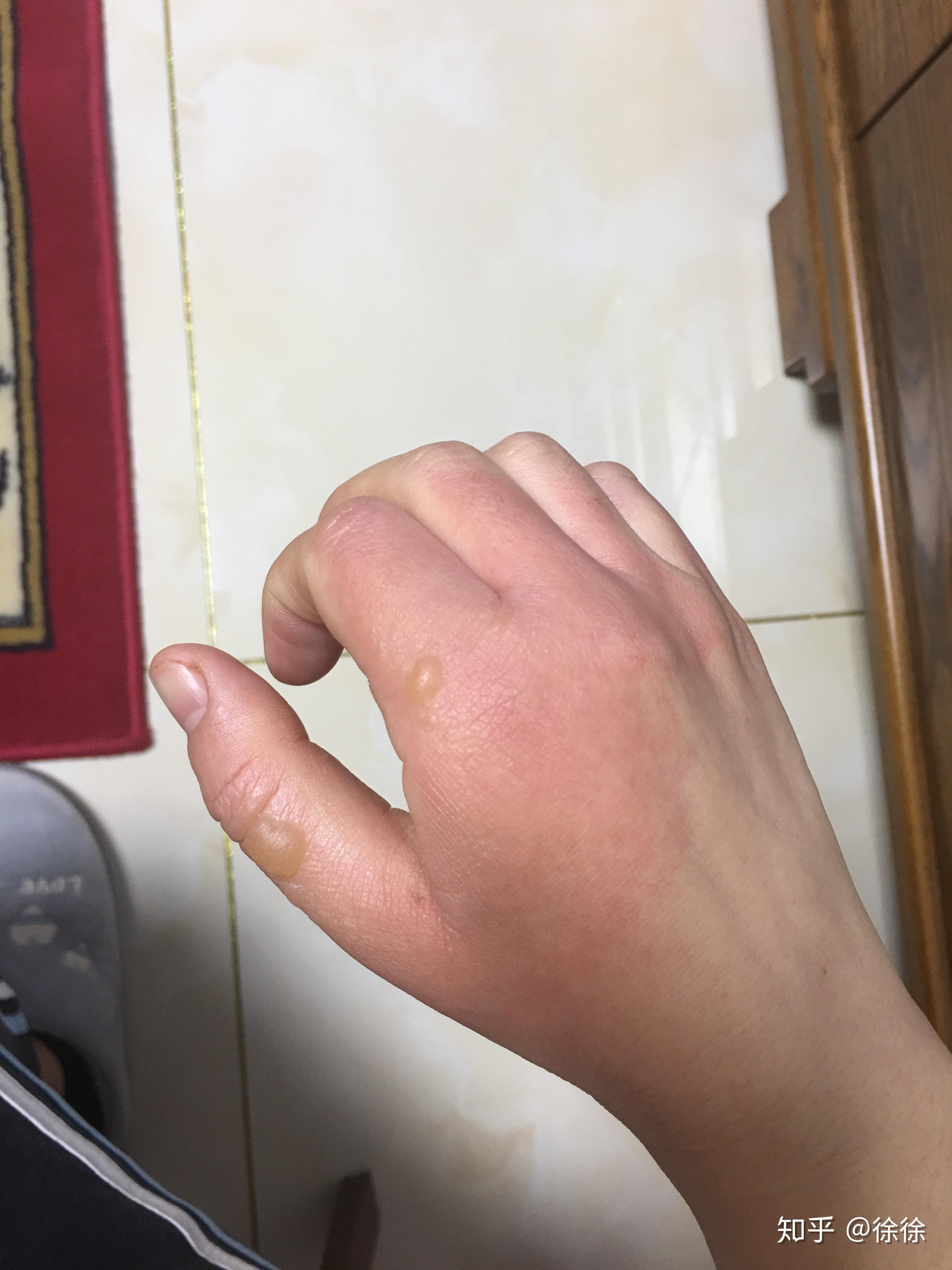 烫伤起的水泡可以戳破吗?