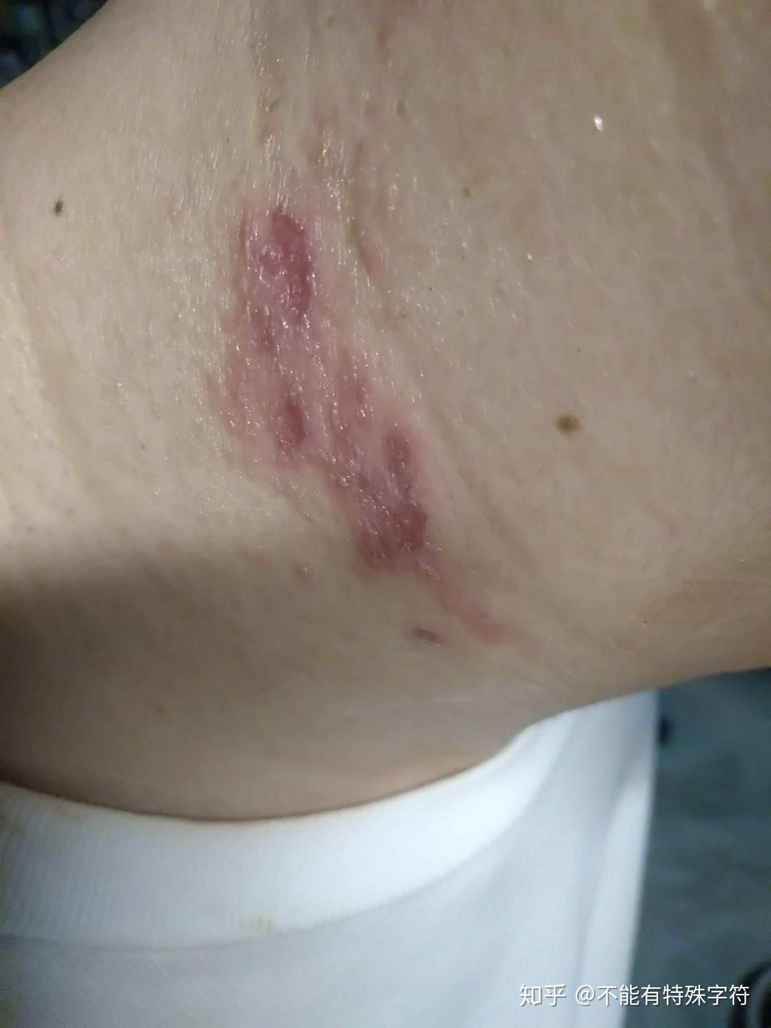 隐翅虫叮咬如何治疗? - 知乎