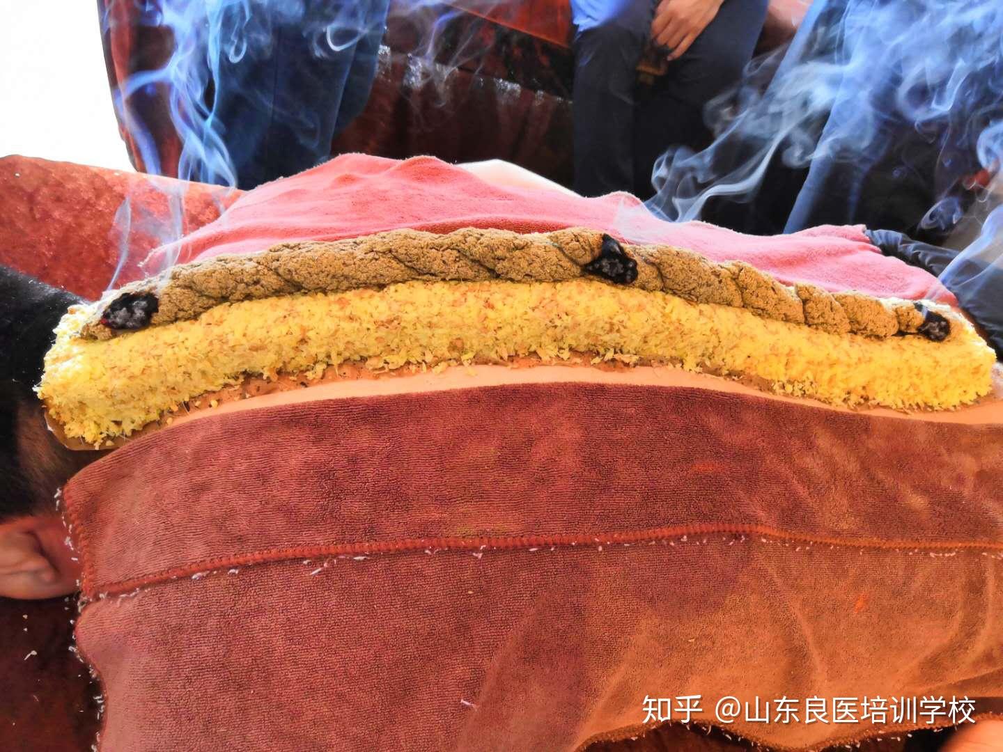 艾灸四个小原则图片为夏季最扶阳的督灸