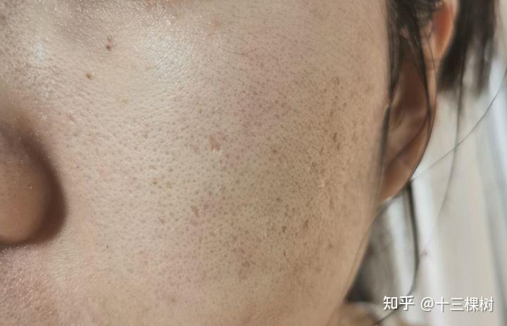 请问这种冰锥型的痘坑现在有什么医美可以解决么痘龄9年了最美好的