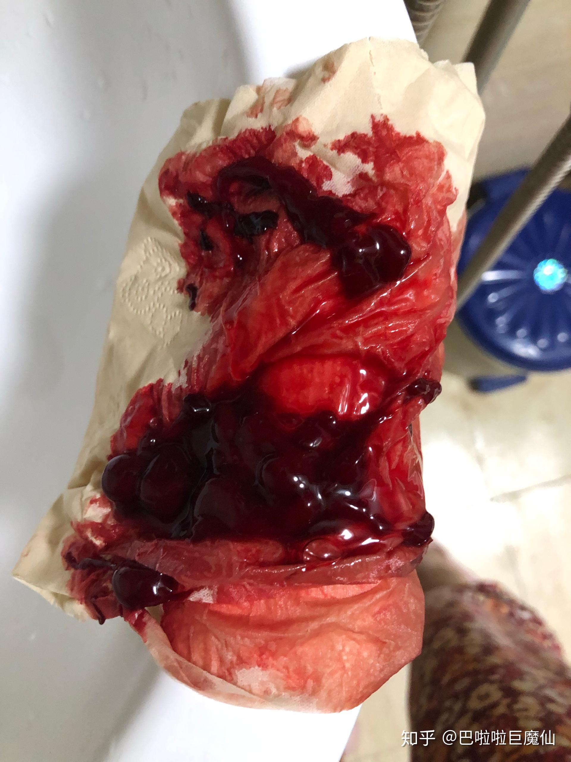 拔了智齿后一直有血块正常吗