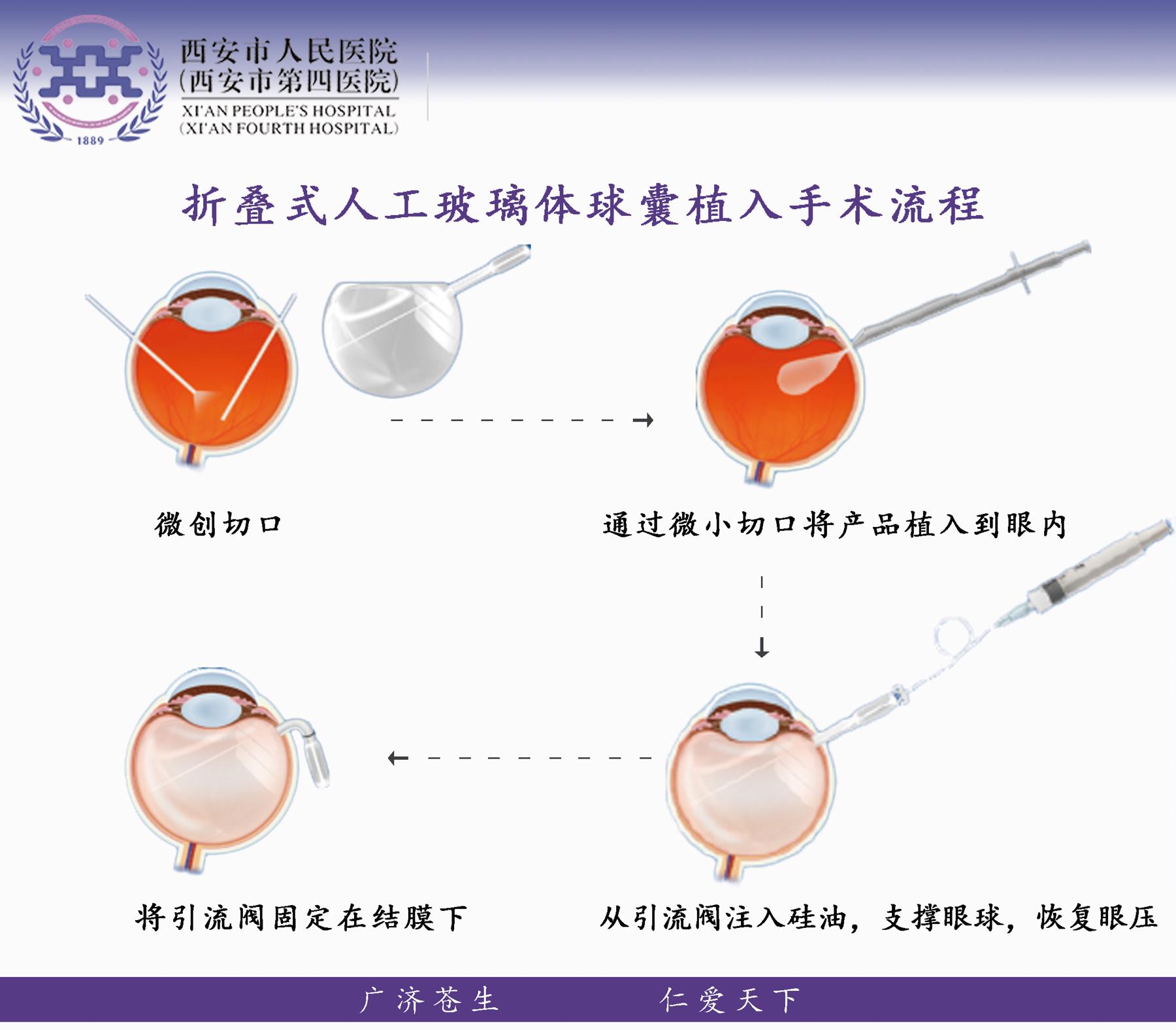 玻璃体切割硅油填充术图片