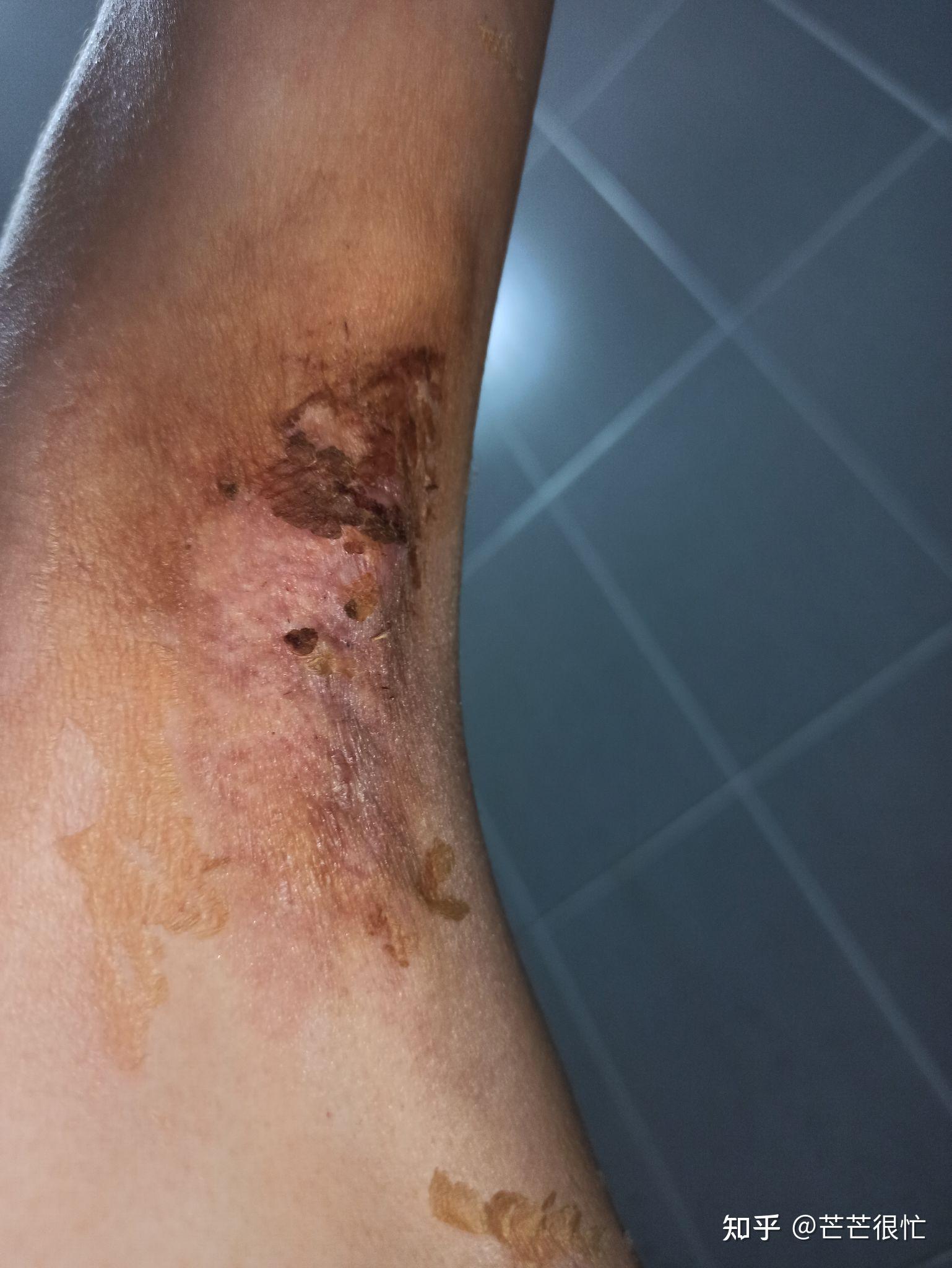 腋下微创手术记录